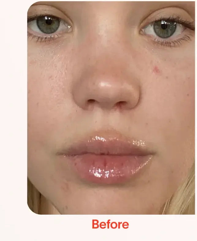 Bye Acne: 3-Minute Pimple Spot Treatment